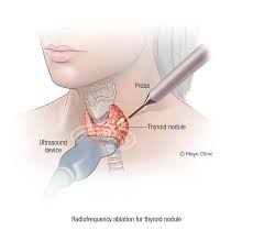 Thyroid